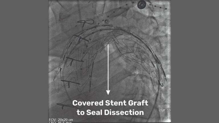 Medical Marvel at SSB Heart and Multispeciality Hospital: Pioneering Hybrid Procedure Saves a Life